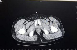 İki yabancı uyruklu yolcunun mide ve bağırsaklarında...