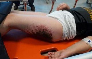 Kartopu oynarken yanan çocuklara doku nakli yapılacak