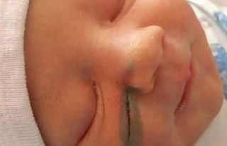 Rusya’da doktorlar doğum sırasında bebeğin yüzünü...