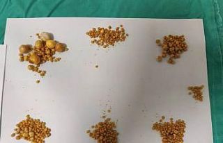 Safra kesesinden binin üzerinde taş çıkarıldı