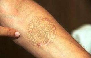 Hayalleri için sildirmek istediği dövmeler kabusu...