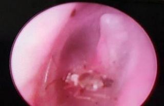 Kulağından canlı sinek çıktı