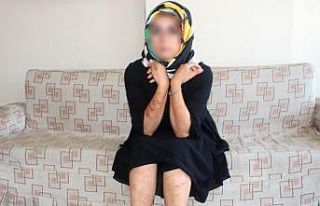 Lazer genç kadının vücudunu yaktı