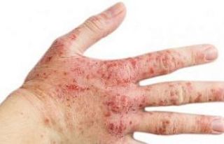 Sizde de bu belirtiler varsa, Rozasea olabilirsiniz