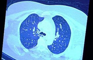 İlaç kullanan korona hastaları ile kullanmayanlar...