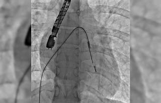 Mitral balon operasyonu adım adım kaydedildi