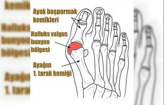 Dar ve sivri burunlu ayakkabılar şekil bozukluğuna...