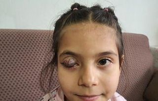 Göz kapağında doğuştan tümör bulunan 7 yaşındaki...