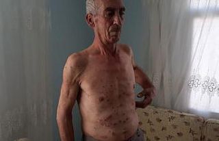 13 yıldır kaşınıyor