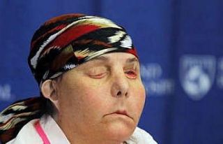 ABD’de iki kez yüz nakli yapılan kadın, ilk kez...