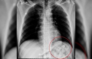 Karnından uyuşturucu zulası çıktı
