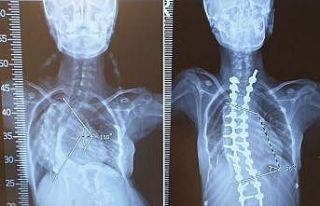 Mersinli skolyoz hastası Medine, ameliyatla yeniden...