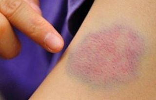 Çocuğunuzun cildinde kolay oluşan morluklara dikkat