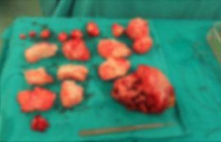 Şişkinlik sandı karnından 1,5 kilo miyom çıktı