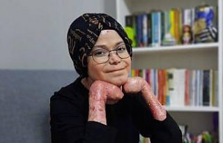 Kelebek Hastası Büşra, sanatsal hobilerle ilgilenerek...