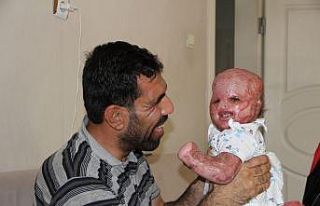 (Özel) ‘Yüzde 90 yaşamaz’ denilen Delal bebek,...