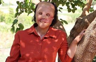 Yüz nakli olan Leyla’dan sevindiren haber