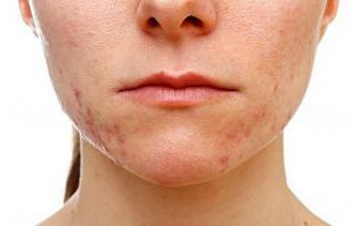 Cildinizi ‘maskne’ye karşı korumanız mümkün