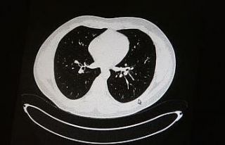 Aşılı ve aşısız olarak koronaya yakalanan 2...