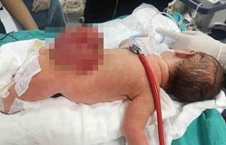 Açık omurga ile doğdu