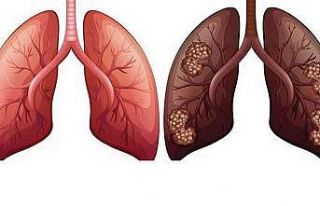Akciğer kanserine yüzde 90 tütün kullanımı neden...