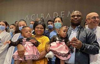 Kamerunlu yapışık ikizler Türkiye’de yeniden...