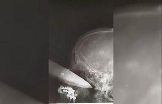 Rusya’da sarhoş koca, eşinin gözüne bıçak...