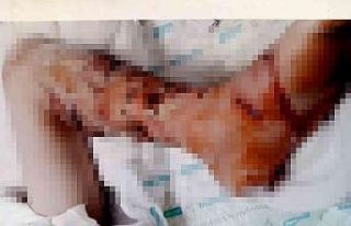 4 yıl önce pitbull saldırısına uğrayan çocuk,...