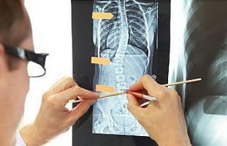 Ebeveynlerin dikkati çocuklarda görülen skolyozun...