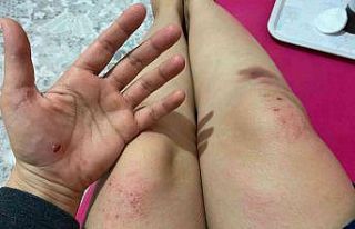 İşe giden kadına köpekler saldırdı