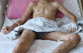 (ÖZEL) 10 köpeğin saldırısına uğrayan 12 yaşındaki...
