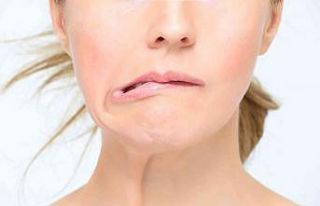 Soğuk hava yüz felcini arttırıyor