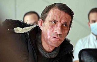 Türkiye’nin ilk yüz nakli 10 yaşında