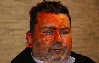 Uyurken dehşeti yaşadı: Kardeşi tarafından yüzünün...