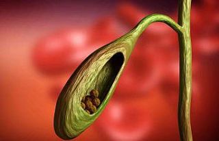 Safra kesesi taşını mide ağrısı ile karıştırmayın