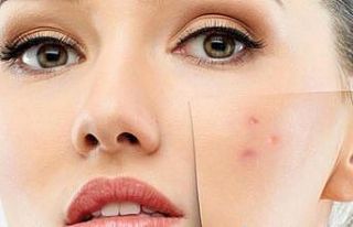 Hassas ve alerjik ciltlere mevsim geçişlerinde dikkat