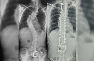 Tokat’tan gelen skolyoz hastası Samsun’da şifa...