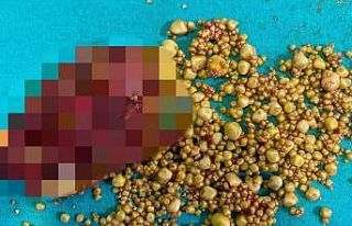 76 yaşındaki hastanın safra kesesinden bin 284...