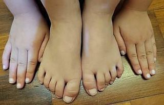 Tayvan’da Covid-19 olan çocuğun tırnakları beyazladı