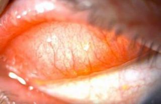 2 gün boyunca gözünde sinek larvası ile yaşadı