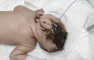 Beyninin yarısı kafatası dışında dünyaya geldi