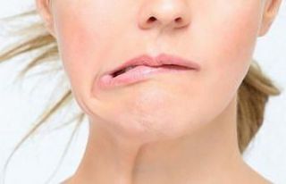 Uzmanından yüz felcine karşı öneriler