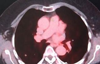 Diyarbakır’da kanser hastaları son nükleer tıp...