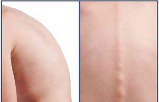 Ebeveynlerin dikkati, çocuklarda görülen skolyozun...