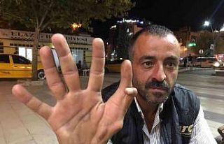 Elazığ’da 11 parmaklı adam görenleri hayrete...