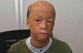 Araç yangınında yüzü yanan sekiz yaşındaki...