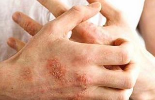 Sonbaharda alerjik egzamaya dikkat