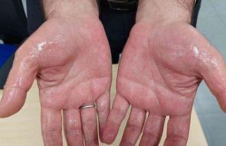 Uzmanından aşırı terleme tavsiyesi: Ertelemeyin