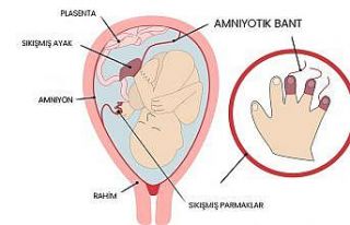Amniyotik bant sendromu olan bebekler anne karnında...