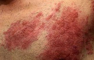 Zayıflayan bağışıklık zona vakalarını artırdı